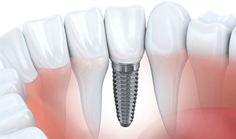 tooth implant dentist in tampa